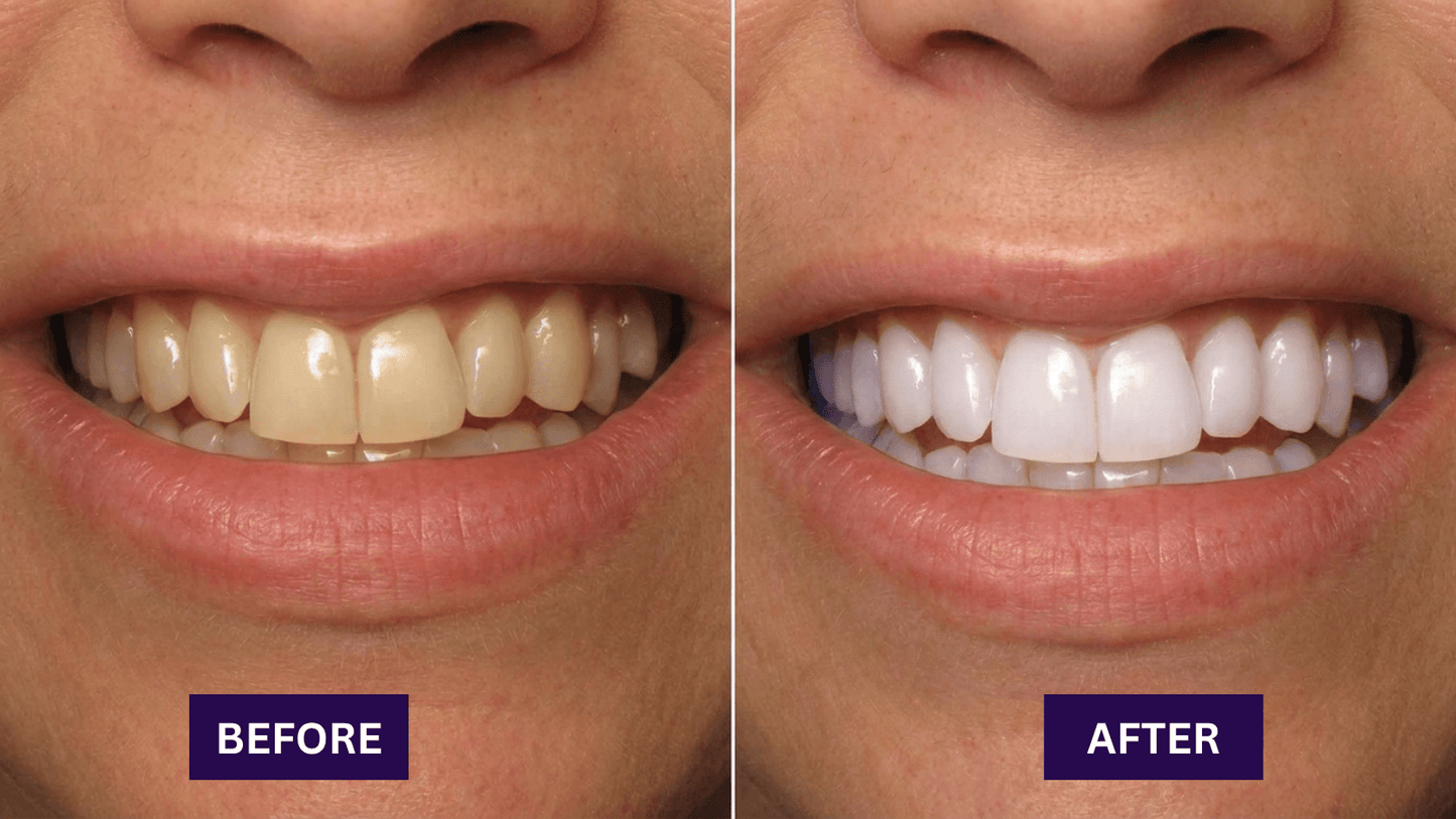 Dr.Whites Purple Whitening Strips