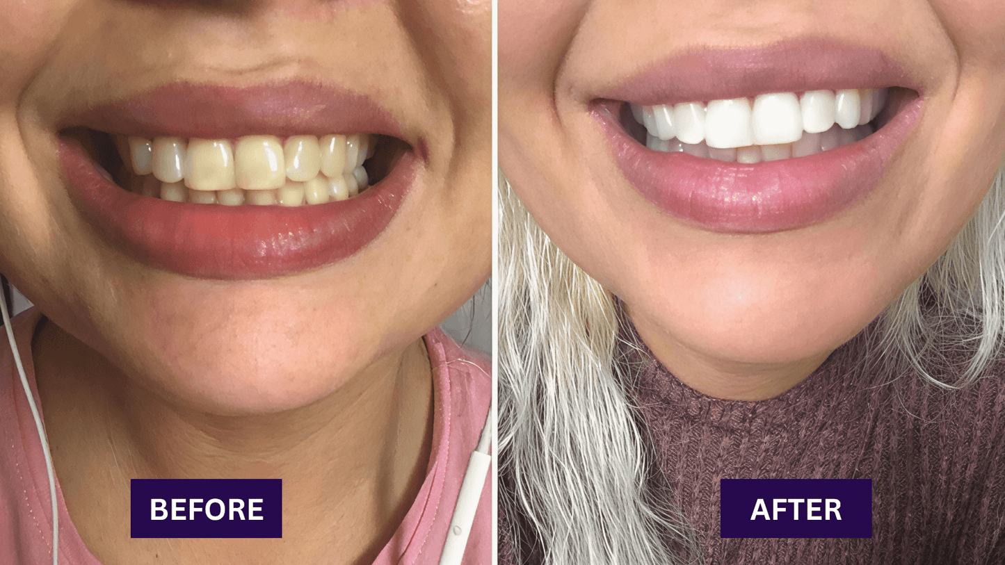 Dr.Whites Purple Whitening Strips