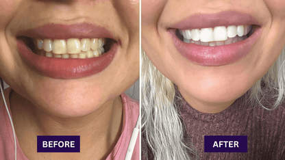 Dr.Whites Purple Whitening Strips